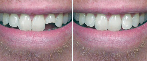 Before & After Cosmetic Bonding