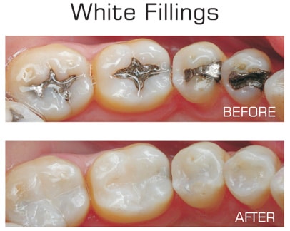 White Fillings in Langley