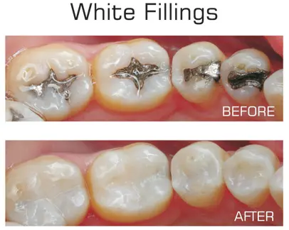 White Fillings in Langley White Fillings in Langley