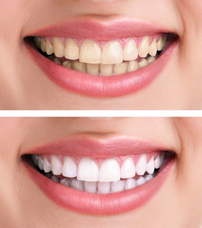 Teeth Whitening in Langley