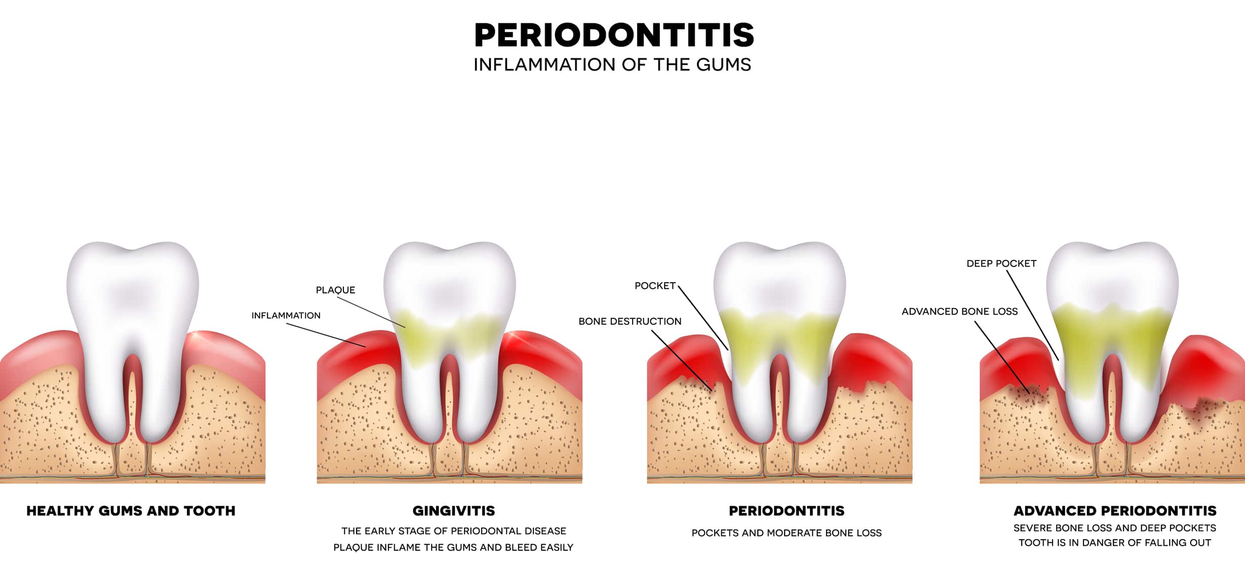 Gum Disease Therapy- Langley, BC