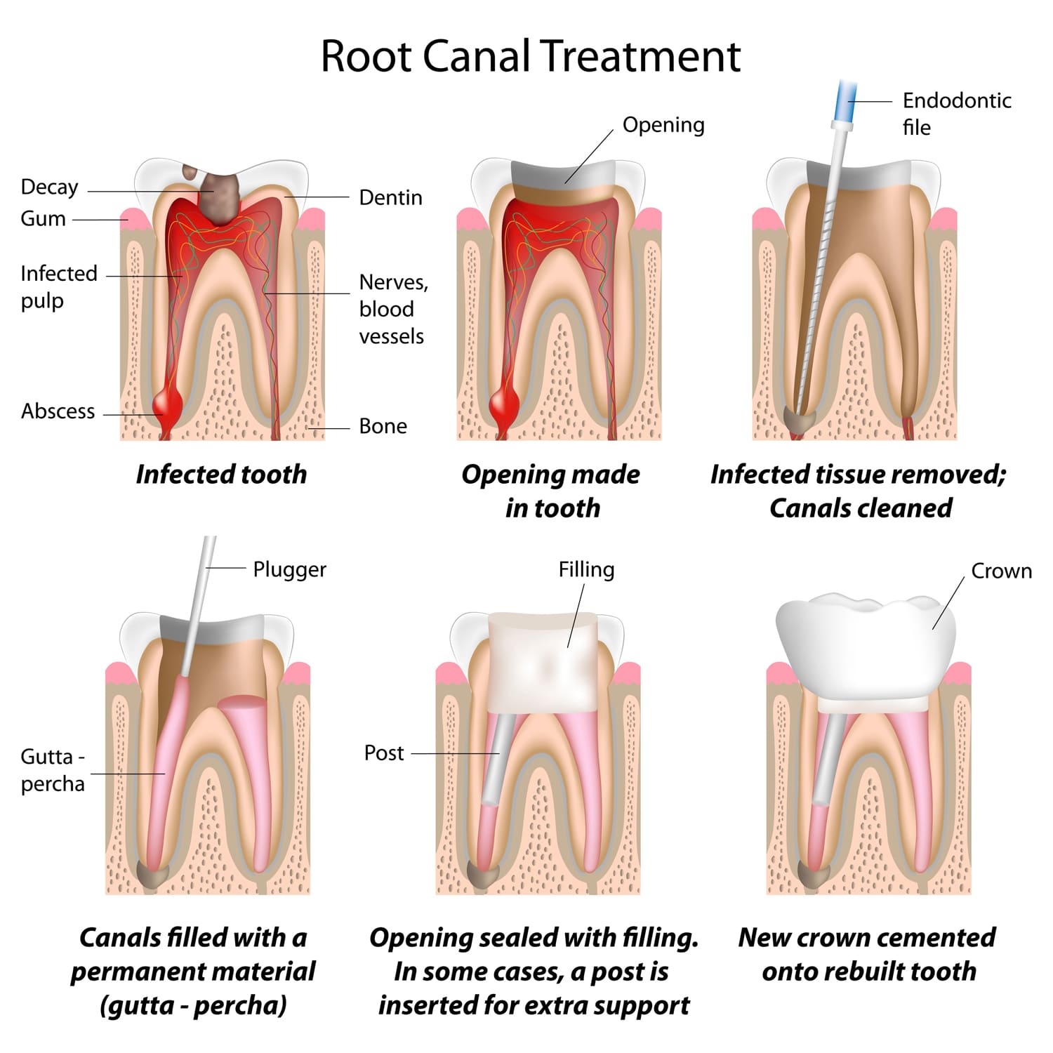 Root Canal Therapy in Langley