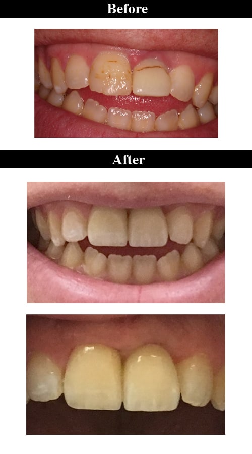 Smile Gallery- Before & After Implant Crowns