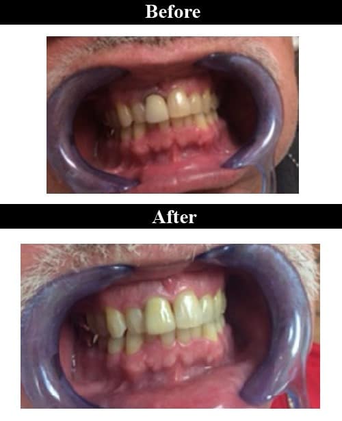 Smile Gallery - Before & After Dental Crowns