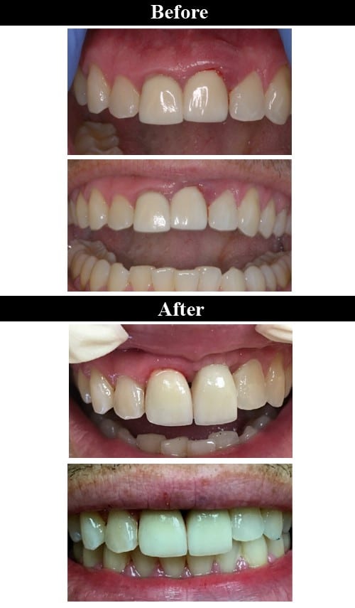 Before & After Implant Crowns