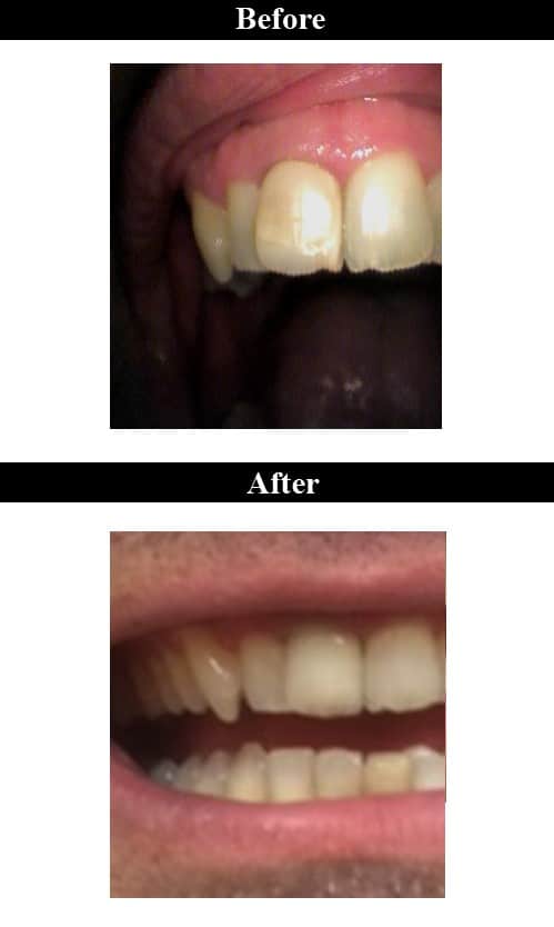 Before & After Ceramic Crowns