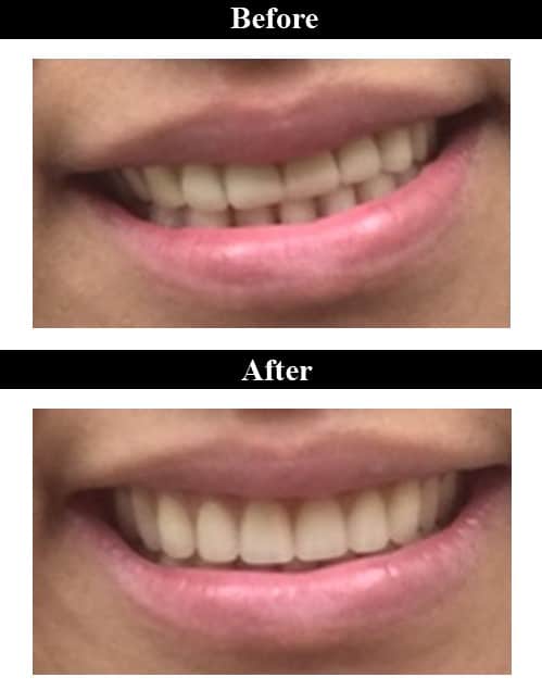 Smile Gallery - Before & After Dentures