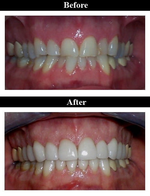 Smile Gallery - Before & After Crowns & Veneers