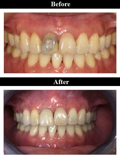 Smile Gallery - Before & After Implant Supported Crown