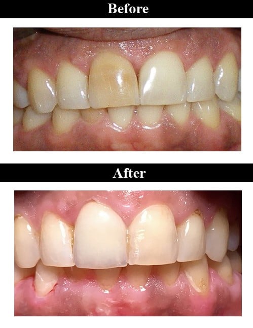 Smile Gallery - Before & After Ceramic Crown