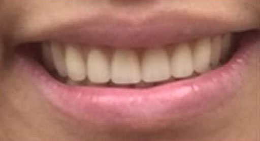 Dental Crown After