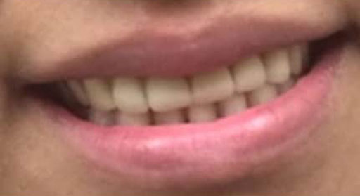 Dental Crown Before