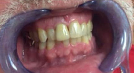 Dental Crown After
