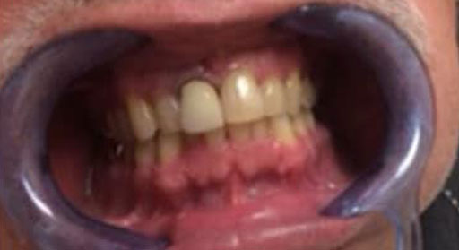 Dental Crown Before