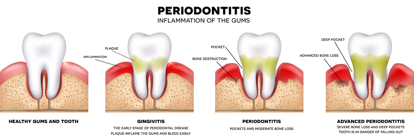 Gum-Disease-Therapy-stages