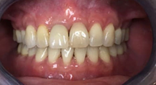 Dental Crown After