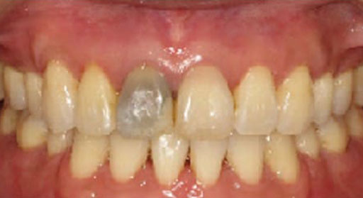 Dental Crown Before