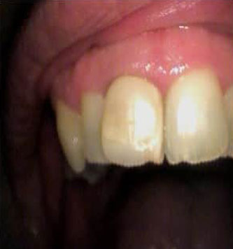 Ceramic Crown Case 1 Before