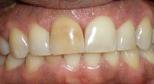 Ceramic Crown Case 2 Before