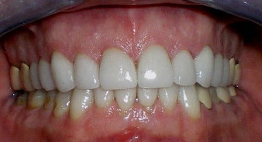 Dental Crown After