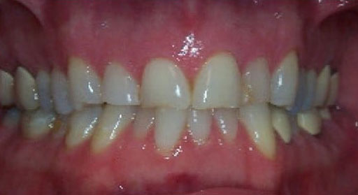 Dental Crown Before