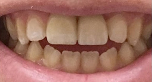 Implant & Crown | Case 1 | After