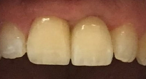 Implant & Crown | Case 1 | After | Close-Up
