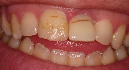 Implant & Crown | Case 1 | Before