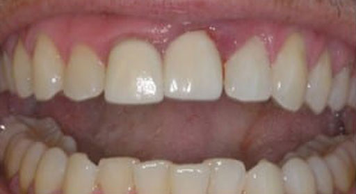 Implant & Crown | Case 2 | Before| | 2nd Photo