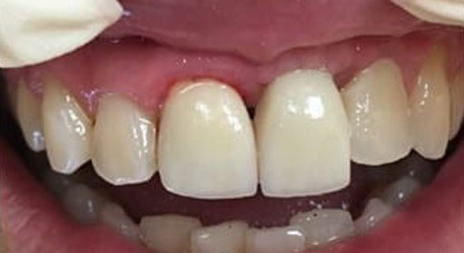 Implant & Crown | Case 2 | After 1