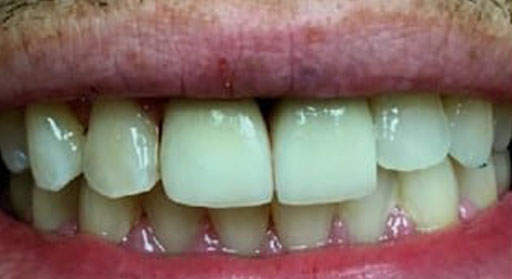 Implant & Crown | Case 2 | After 2
