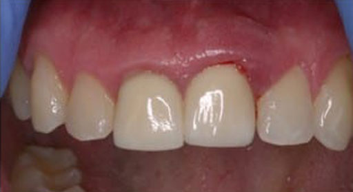 Implant & Crown | Case 2 | Before