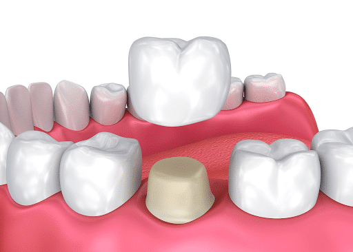 Northtown Dental - Dental Crowns Northtown Dental -Crowns in North York