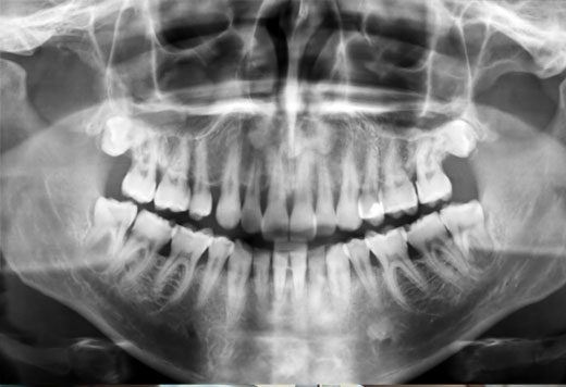 Digital Xray